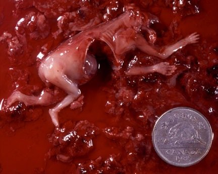 abortion11-week